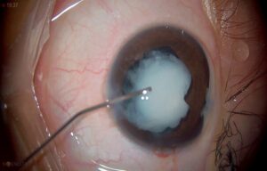 https://lunaticprophet.org/reasons-to-inquire-about-cataract-surgery-near-me/