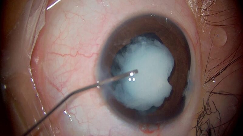 Reasons To Inquire About Cataract Surgery Near Me