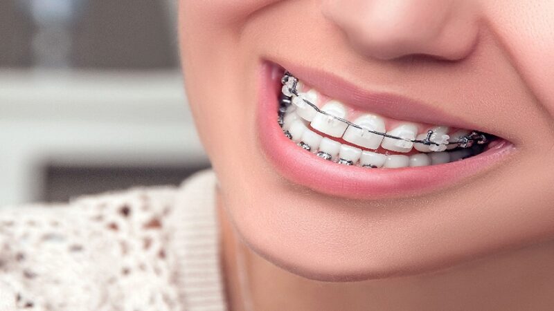 Lingual Braces: The Benefits and Drawbacks of Back Braces