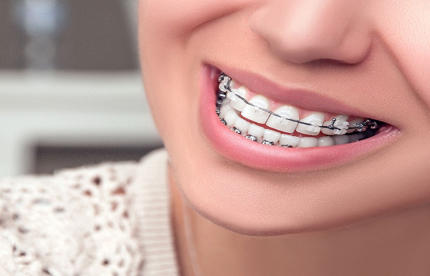 Lingual Braces: The Benefits and Drawbacks of Back Braces