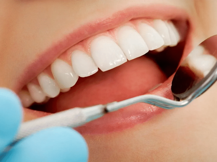 Veneers Newport Beach: Are Porcelain Veneers Worth the Investment?